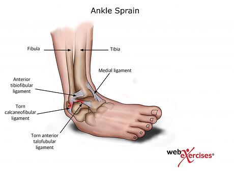 Ankle Sprain